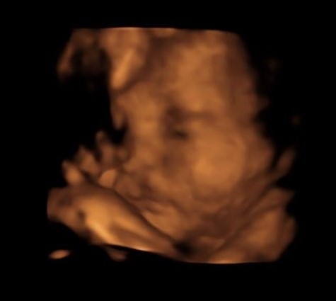 HB364 Abortion Revisions (Ultrasound bill)